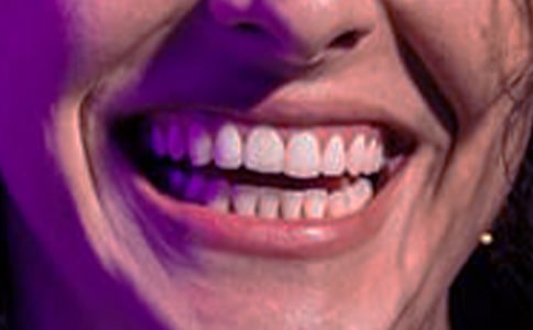 孩子牙齦增生的眾多原因及應(yīng)對(duì)措施